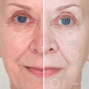 NIRA Precision Anti-Ageing Laser